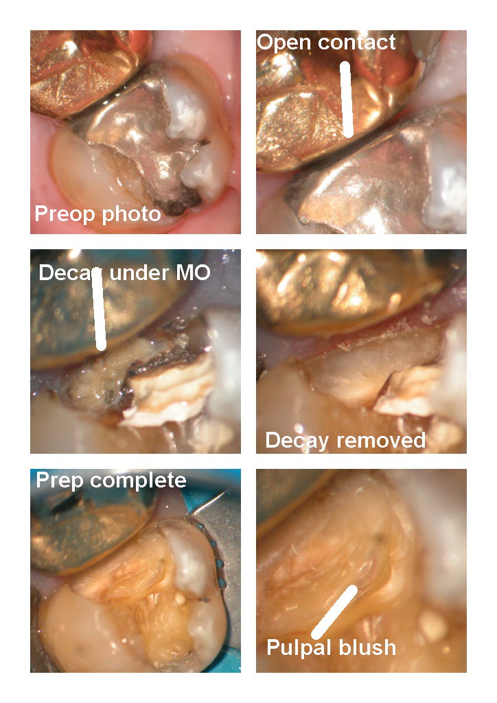 Crown prep BS pg 1.jpg